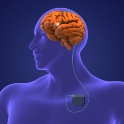 DBS recovery: a male graphic with an orange brain and a single lead leading down to his pacemaker.